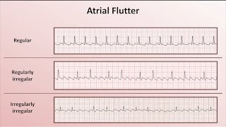 Intro to EKG Interpretation  Overview of Tachyarrhythmias [upl. by Fidelis]