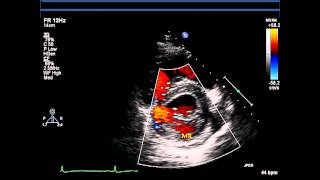 Parasternal Short Axis Views  Echocardiography [upl. by Acsicnarf667]