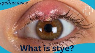 Stye How to get rid of stye fast stye or Chalazion [upl. by Adnamaa]