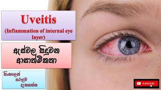 Uveitis ඇස් වල ආසාත්මිකතා how it happens causes symptoms treatments prevent [upl. by Blanchard]