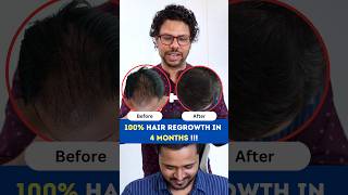 100 Hair Regrowth in 4 Months  Hair Loss  Hair Regrowth  Hair Fall  Adon Hair Care viral [upl. by Tremaine100]