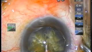 hard cataract quick horizontal chop [upl. by Margot]