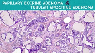 Papillary Eccrine AdenomaTubular Apocrine Adenoma Dermpath in 5 Minutes [upl. by Brenden]