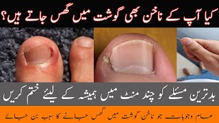 Nakhun Ka Goshat Main Ghus Jana  Nail Treatment At Home  Iqra Naeem Writes  Latest Health Video [upl. by Zoes]