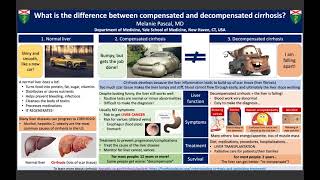 quotWhat is the difference between compensation and decompensated cirrhosisquot  Melanie Pascal [upl. by Neiman294]