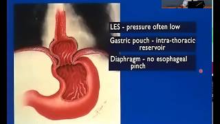 Gastroenterology ECHO GERD  51117 [upl. by Leviralc]