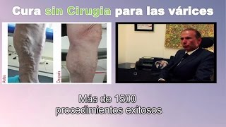 Cura para venas varices SIN CIRUGIA en Bogota Colombia  Tratamiento Ulceras varicosas Linfedema [upl. by Eillom]