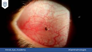 Educational Video 38 Conjunctival FB removal under slit lamp [upl. by Ordnagela]