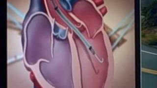 Impella 50 animation showing how it aids heart failure patients [upl. by Clea597]