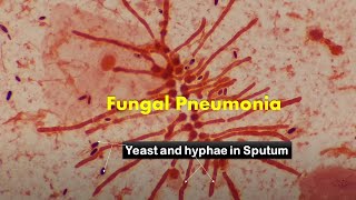 Heavy load of fungus in Sputum Microscopy [upl. by Rusticus]