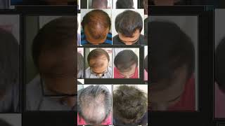 Best Hair Fall Treatment in Coimbatore coimbatore haircare [upl. by Trueman]