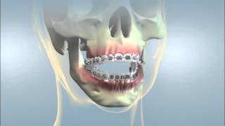 YORK ORTHODONTICS Orthognathic Surgery Open Bite [upl. by Zetra]