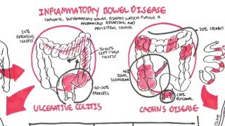 Inflammatory Bowel Disease  Crohns and Ulcerative Colitits [upl. by Okim736]