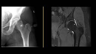 What is an MRI hip arthrogram [upl. by Bernard]