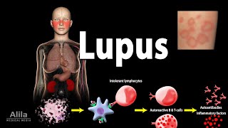 Lupus Symptoms Risk factors Pathophysiology Diagnosis and Treatments [upl. by Oech]