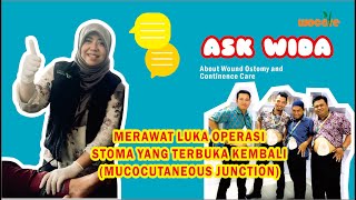 ASK WIDA 19 LUKA OPERASI STOMA TERBUKA KEMBALI MUCOCUTANEOUS JUNCTION [upl. by Annairdna]