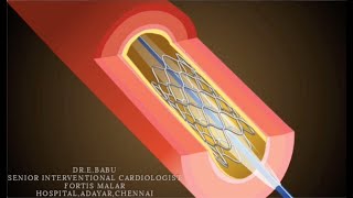 What is Coronary Angioplasty Stenting PTCA Dr E Babu Cardiologist Fortis Malar Hospital Chennai [upl. by Akinohs]