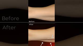 Arm fat Bingo Wing removal using coolsculpting shorts [upl. by Einafats]