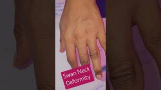 Swan Neck Deformity imwell arthritis Jointpain Pain rheumatism [upl. by Ellissa]