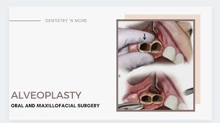 ALVEOLOPLASTY  DEANS ALVEOLOPLASTY  OBWEGESERS ALVEOLOPLASTY  ALVEOLECTOMY [upl. by Eissak350]