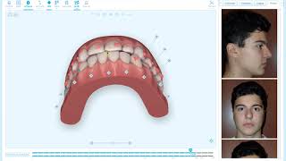 Quick Tip  Bite Correction Visualization in Aligners [upl. by Ennayar]