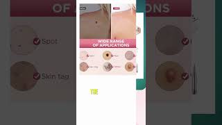 Best Skin Tag Removal Kit Reviews  Best Reviews Blog 2023 [upl. by Che]