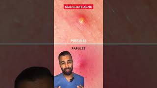 Dr Somji explains how to treat Acne Mild Moderate amp Severe Acne [upl. by Akimrej]