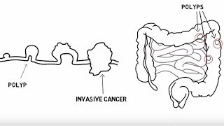 The Basics of Colorectal Cancer 5 Ws [upl. by Lexis]