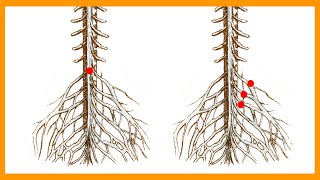 Cauda Equina vs Conus Medullaris Syndrome [upl. by Whitebook205]