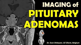 Imaging of Pituitary Adenomas [upl. by Gelasias590]