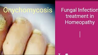 Onychomycosis In Homeopathy quick treatment [upl. by Scotney519]