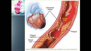 Ischemia  Myocardial Ischemia amp Its causes [upl. by Ddahc]