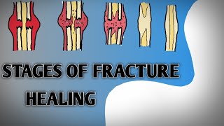 Stages of Fracture healing cortical and Cancellous bone in hindi amp English corticalbonehealing [upl. by Arorua]