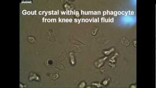 Live Synovial Gout phagocyte Showing Negative Birefringent Characteristic MSU Crystal [upl. by Shlomo]