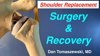 Shoulder Replacement surgery and recovery [upl. by Seltzer]