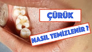 Çürük Diş Nasıl Temizlenir [upl. by Angie]