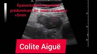 Colite Aiguë Ulcéreuse Hémorragique Colon Gauche Échographie [upl. by Tansy]