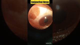 Conjunctival Nevus  Optometry with ShahideyesConjunctivalNevus eyes optometry [upl. by Fink326]