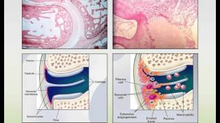 Rheumatoid Arthritis and Systemic Lupus Erythematosus Webinar [upl. by Trina]