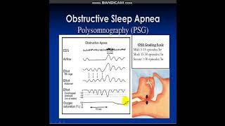 polysomnography [upl. by Gabriel]