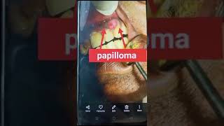 papilloma removed by Laser excellent response By DrCParya MDS Dip in Laser [upl. by Nimsaj39]