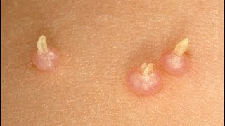 moluscos contagiosos Causas sintomas como se contagia tratamiento fotos [upl. by Clo]