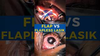 Flap VS Flapless Lasik [upl. by Novelia]