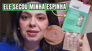 Testei CURATIVO HIDROCOLOIDE PARA ACNE nas minhas Espinhas Marca Needs  Resenha [upl. by Lorin]