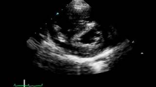 A 17YearOld Girl with Chest Pain and Hemoptysis [upl. by Manvel329]