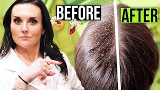 How to Get Rid of Lice FAST 1 Hour Lice Treatment [upl. by Hpeosj]