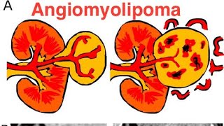 Angiomyolipoma [upl. by Truda544]