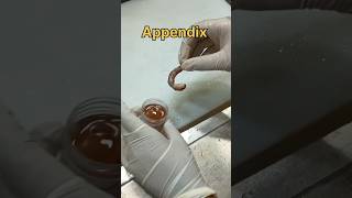 Appendicitis specimen [upl. by Niffirg652]