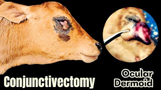 Conjunctivectomy  Dr Md Abu Bakar Ahad [upl. by Markland]