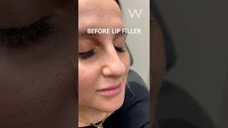 Before and after Restylane Kysse Lip Filler results [upl. by Vijar10]